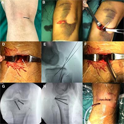 Treatment of avulsion fracture of posterior cruciate ligament tibial insertion by minimally invasive approach in posterior medial knee